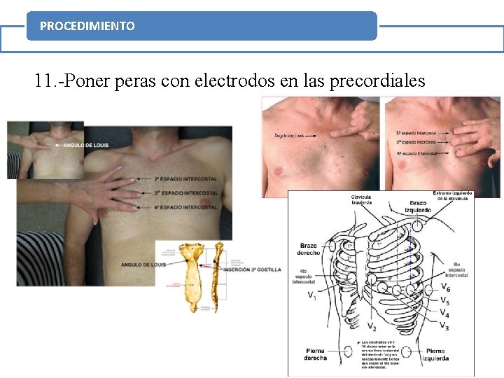 PROCEDIMIENTO 11. -Poner peras con electrodos en las precordiales 18 
