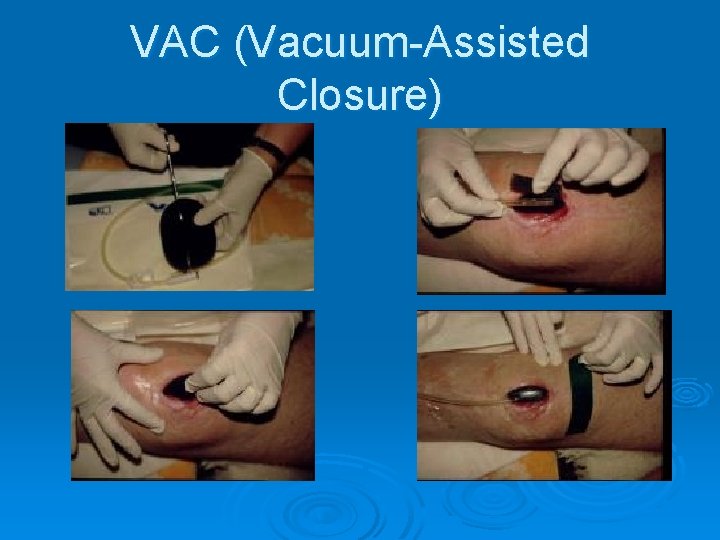 VAC (Vacuum-Assisted Closure) VAC (Vacuum-Assisted Closure)