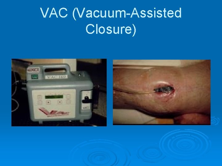 VAC (Vacuum-Assisted Closure) 