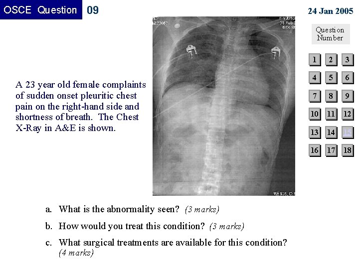 OSCE Question 09 24 Jan 2005 Question Number A 23 year old female complaints OSCE Question 09 24 Jan 2005 Question Number A 23 year old female complaints