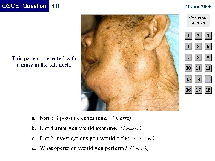 OSCE Question 10 24 Jan 2005 Question Number This patient presented with a mass OSCE Question 10 24 Jan 2005 Question Number This patient presented with a mass