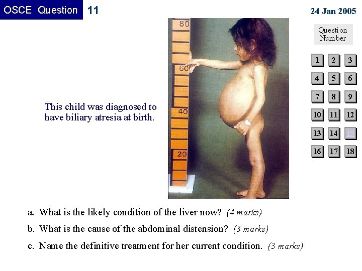 OSCE Question 11 24 Jan 2005 Question Number This child was diagnosed to have OSCE Question 11 24 Jan 2005 Question Number This child was diagnosed to have