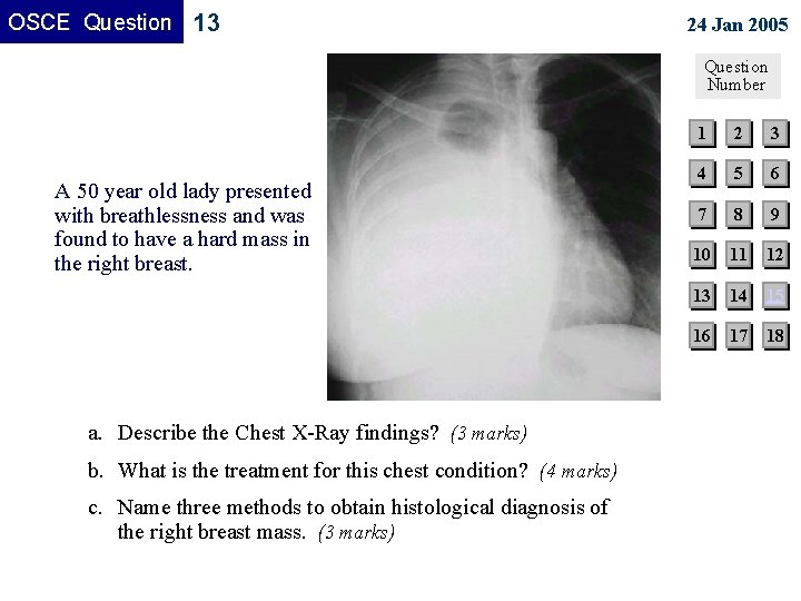 OSCE Question 13 24 Jan 2005 Question Number A 50 year old lady presented OSCE Question 13 24 Jan 2005 Question Number A 50 year old lady presented