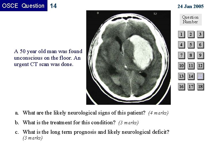 OSCE Question 14 24 Jan 2005 Question Number A 50 year old man was OSCE Question 14 24 Jan 2005 Question Number A 50 year old man was