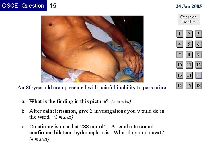 OSCE Question 15 24 Jan 2005 Question Number An 80 -year old man presented OSCE Question 15 24 Jan 2005 Question Number An 80 -year old man presented