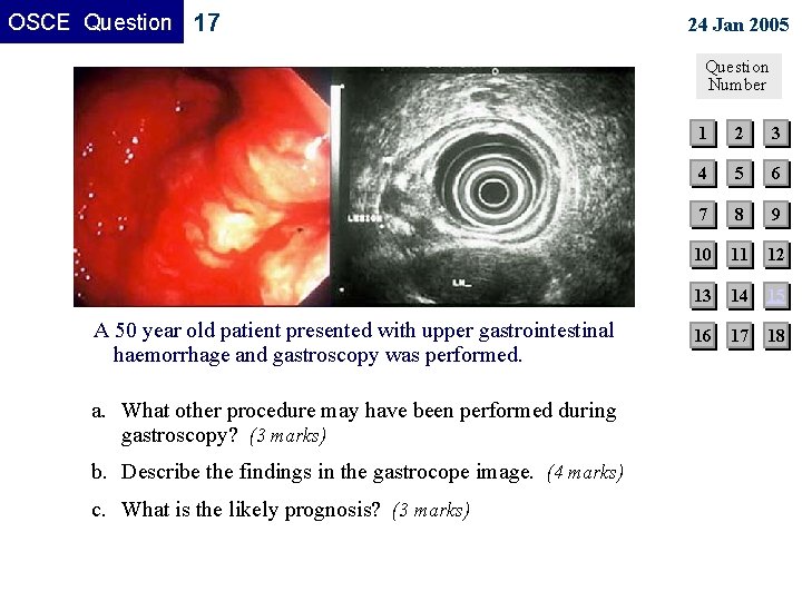 OSCE Question 17 24 Jan 2005 Question Number A 50 year old patient presented OSCE Question 17 24 Jan 2005 Question Number A 50 year old patient presented