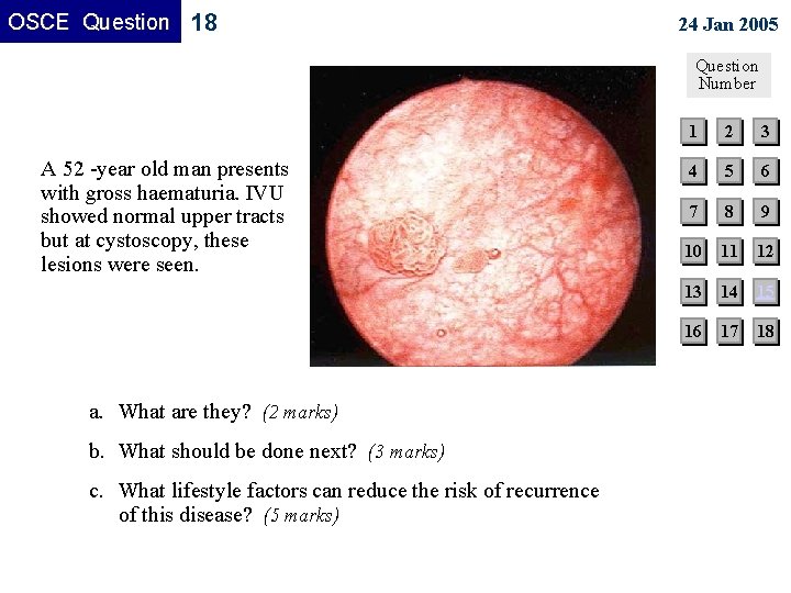 OSCE Question 18 24 Jan 2005 Question Number A 52 -year old man presents OSCE Question 18 24 Jan 2005 Question Number A 52 -year old man presents