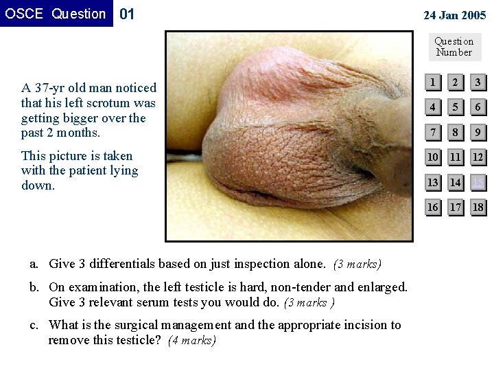 OSCE Question 01 24 Jan 2005 Question Number A 37 -yr old man noticed OSCE Question 01 24 Jan 2005 Question Number A 37 -yr old man noticed