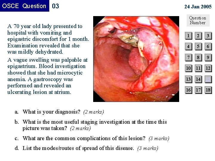 OSCE Question 03 A 70 year old lady presented to hospital with vomiting and OSCE Question 03 A 70 year old lady presented to hospital with vomiting and