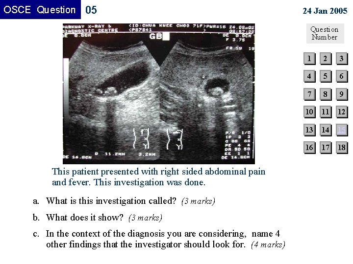 OSCE Question 05 24 Jan 2005 Question Number This patient presented with right sided OSCE Question 05 24 Jan 2005 Question Number This patient presented with right sided