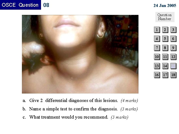 OSCE Question 08 24 Jan 2005 Question Number a. Give 2 differential diagnoses of OSCE Question 08 24 Jan 2005 Question Number a. Give 2 differential diagnoses of