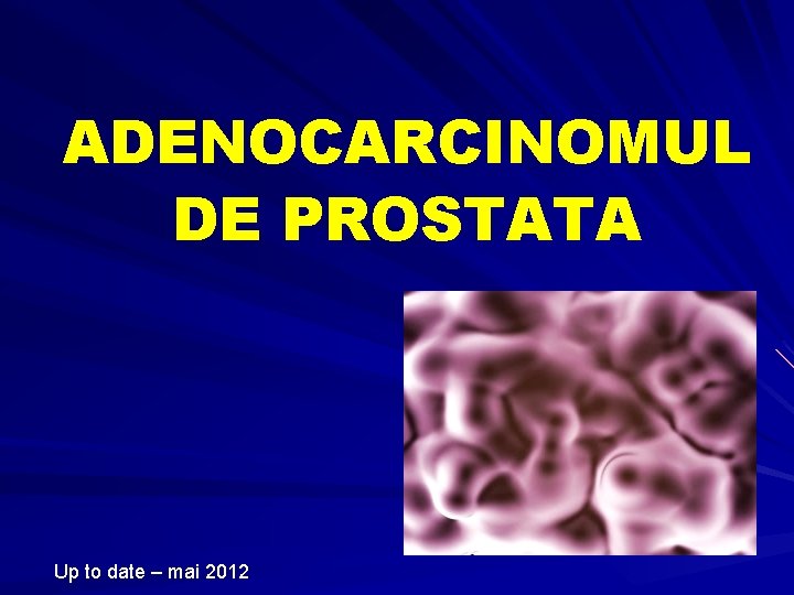 nodul hipoecogen prostata