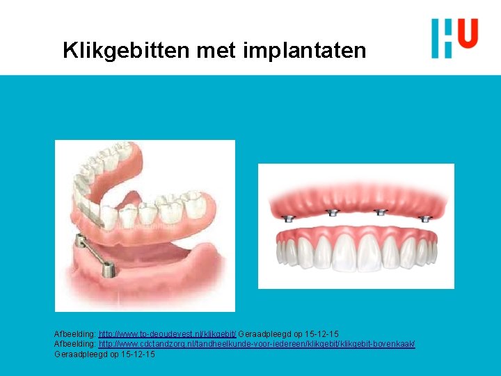 Klikgebitten met implantaten Afbeelding: http: //www. tp-deoudevest. nl/klikgebit/ Geraadpleegd op 15 -12 -15 Afbeelding: Klikgebitten met implantaten Afbeelding: http: //www. tp-deoudevest. nl/klikgebit/ Geraadpleegd op 15 -12 -15 Afbeelding: