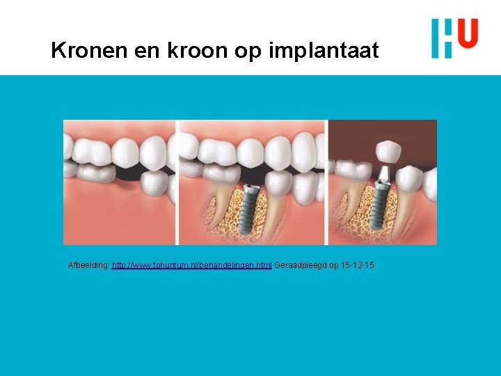 Kronen en kroon op implantaat Afbeelding: http: //www. tphuntum. nl/behandelingen. html Geraadpleegd op 15 Kronen en kroon op implantaat Afbeelding: http: //www. tphuntum. nl/behandelingen. html Geraadpleegd op 15