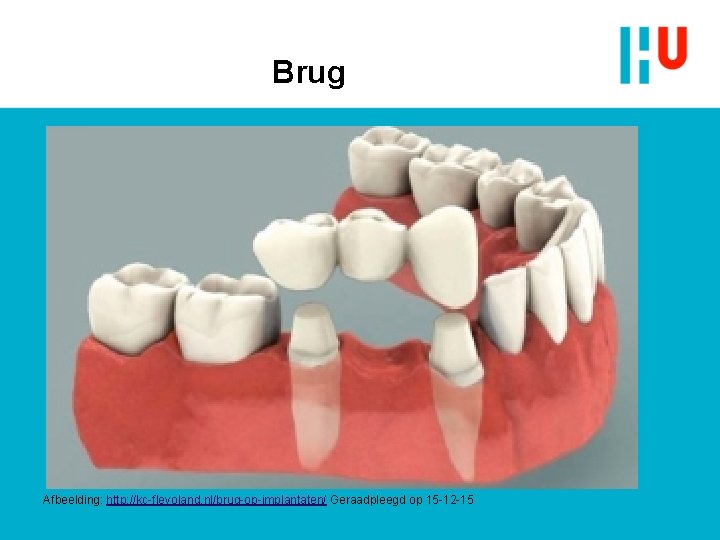 Brug Afbeelding: http: //kc-flevoland. nl/brug-op-implantaten/ Geraadpleegd op 15 -12 -15 Brug Afbeelding: http: //kc-flevoland. nl/brug-op-implantaten/ Geraadpleegd op 15 -12 -15