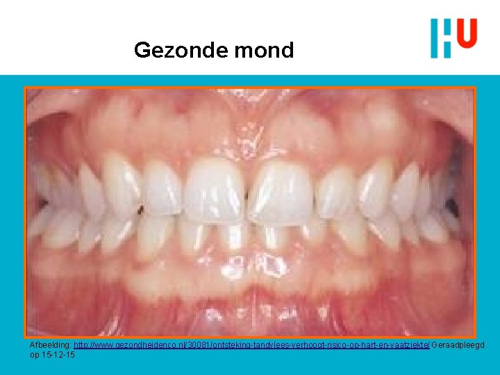 Gezonde mond Afbeelding: http: //www. gezondheidenco. nl/30081/ontsteking-tandvlees-verhoogt-risico-op-hart-en-vaatziekte/ Geraadpleegd op 15 -12 -15 Gezonde mond Afbeelding: http: //www. gezondheidenco. nl/30081/ontsteking-tandvlees-verhoogt-risico-op-hart-en-vaatziekte/ Geraadpleegd op 15 -12 -15