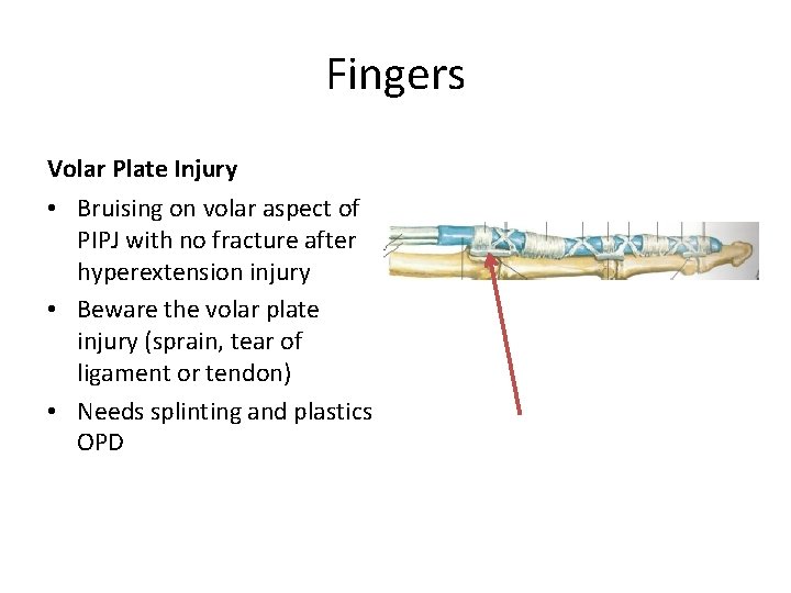 Fingers Volar Plate Injury • Bruising on volar aspect of PIPJ with no fracture