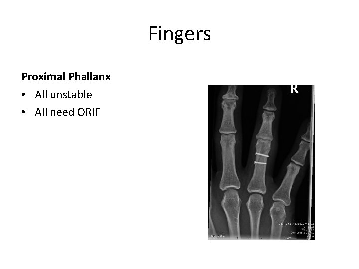 Fingers Proximal Phallanx • All unstable • All need ORIF 