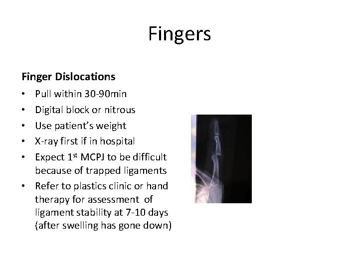 Fingers Finger Dislocations Pull within 30 -90 min Digital block or nitrous Use patient’s