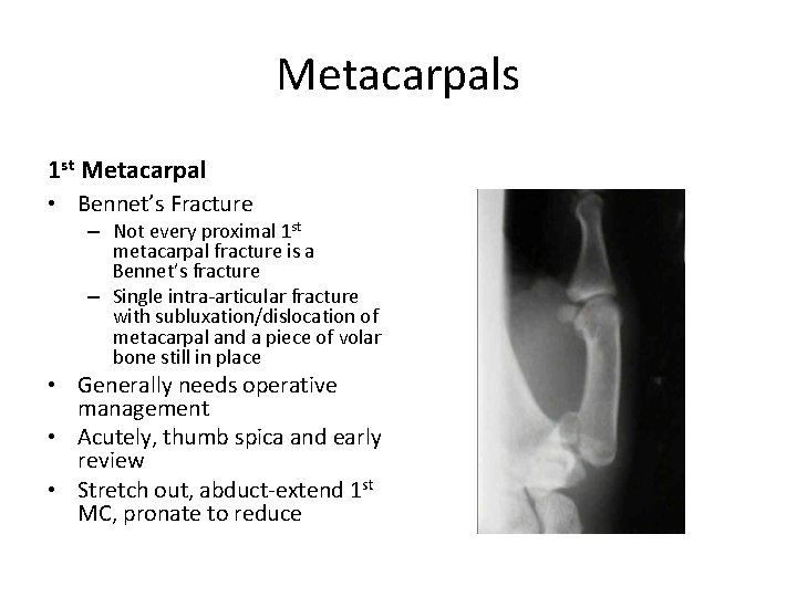 Metacarpals 1 st Metacarpal • Bennet’s Fracture – Not every proximal 1 st metacarpal