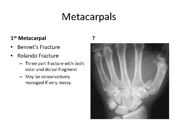 Metacarpals 1 st Metacarpal • Bennet’s Fracture • Rolando Fracture – Three part fracture