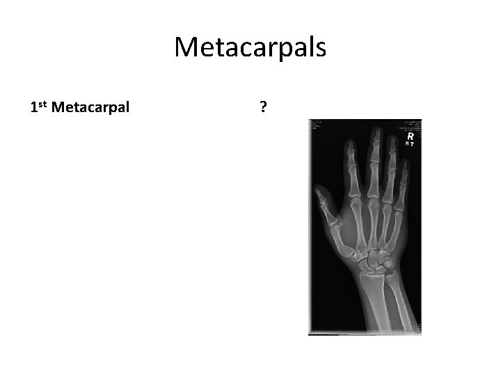 Metacarpals 1 st Metacarpal ? 