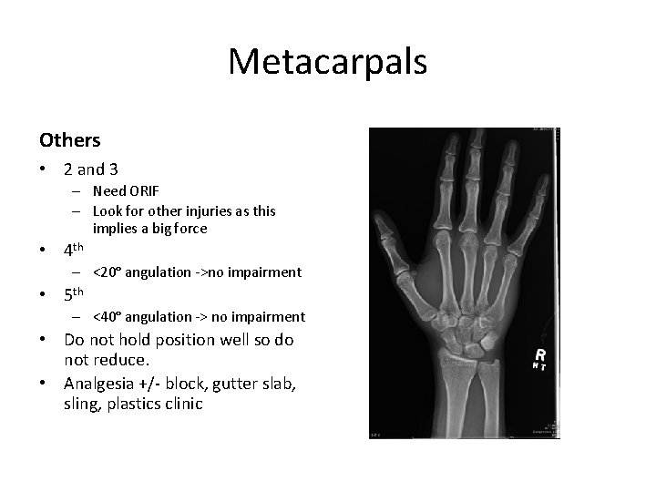 Metacarpals Others • 2 and 3 – Need ORIF – Look for other injuries