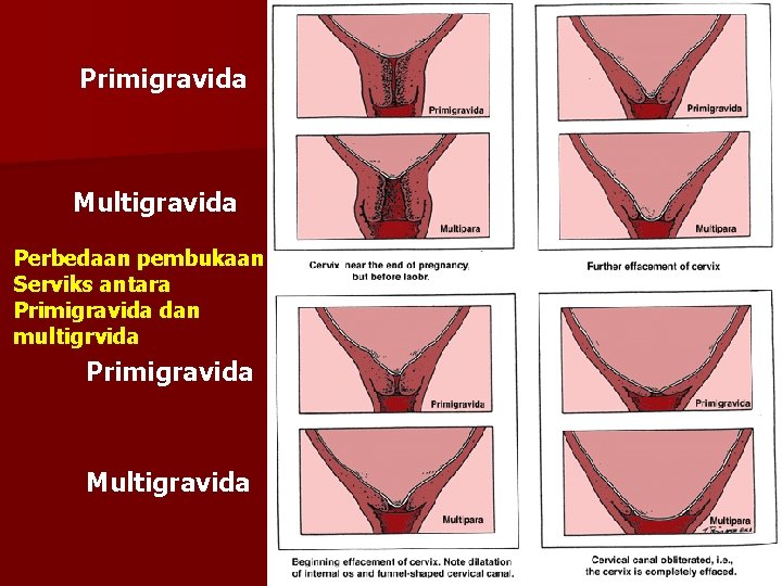 Primigravida Multigravida Perbedaan pembukaan Serviks antara Primigravida dan multigrvida Primigravida Multigravida 
