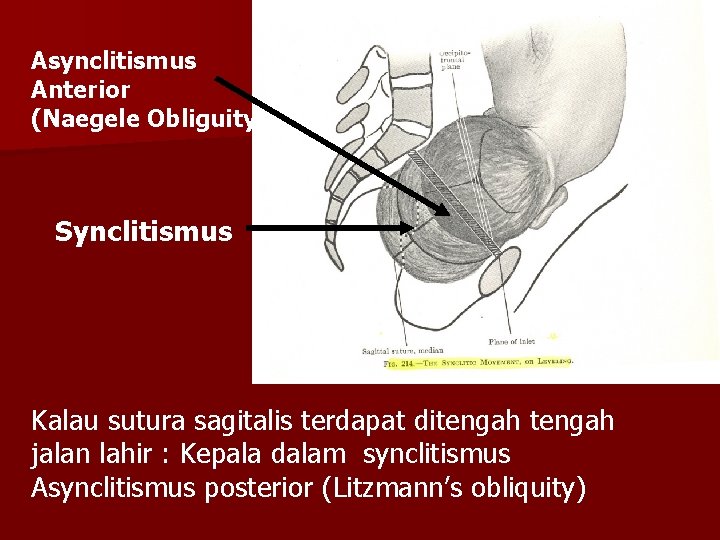 Asynclitismus Anterior (Naegele Obliguity) Synclitismus Kalau sutura sagitalis terdapat ditengah jalan lahir : Kepala