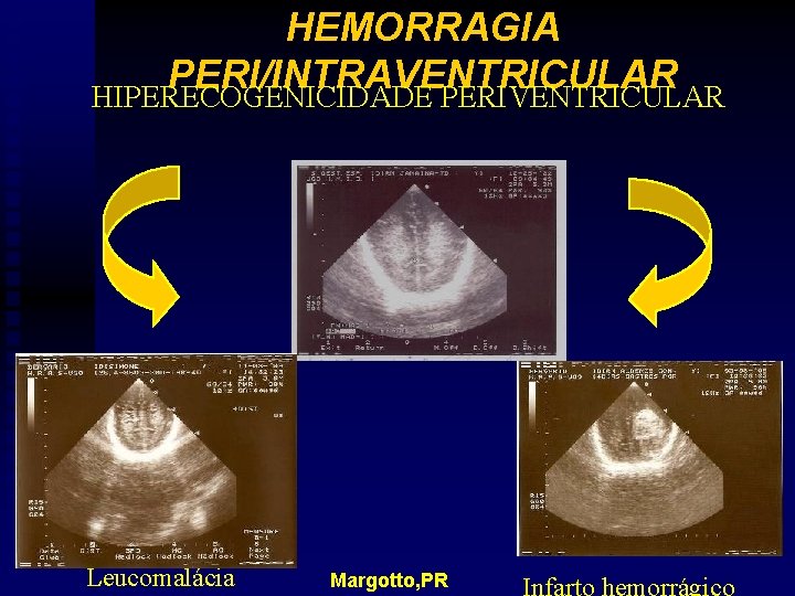 HEMORRAGIA PERI/INTRAVENTRICULAR HIPERECOGENICIDADE PERIVENTRICULAR Leucomalácia Margotto, PR 