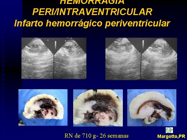 HEMORRAGIA PERI/INTRAVENTRICULAR Infarto hemorrágico periventricular RN de 710 g- 26 semanas Margotto, PR 