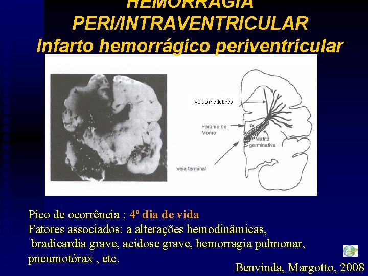 HEMORRAGIA PERI/INTRAVENTRICULAR Infarto hemorrágico periventricular Pico de ocorrência : 4º dia de vida Fatores