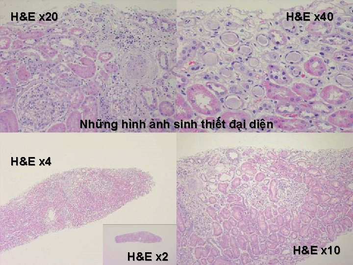 H&E x 20 H&E x 40 Những hình ảnh sinh thiết đại diện H&E H&E x 20 H&E x 40 Những hình ảnh sinh thiết đại diện H&E