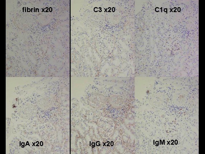 fibrin x 20 Ig. A x 20 C 3 x 20 Ig. G x