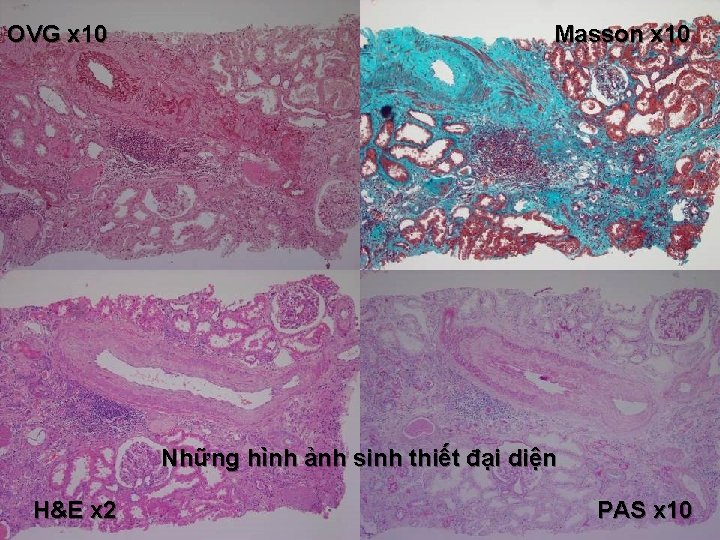 OVG x 10 Masson x 10 Những hình ảnh sinh thiết đại diện H&E