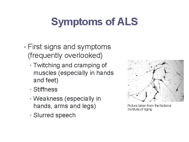 Symptoms of ALS • First signs and symptoms (frequently overlooked) • Twitching and cramping