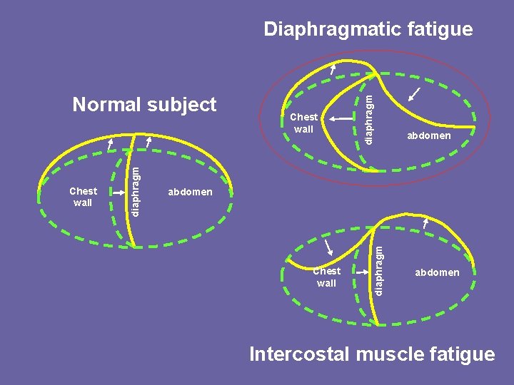 Chest wall abdomen Chest wall diaphragm Normal subject diaphragm Diaphragmatic fatigue abdomen Intercostal muscle