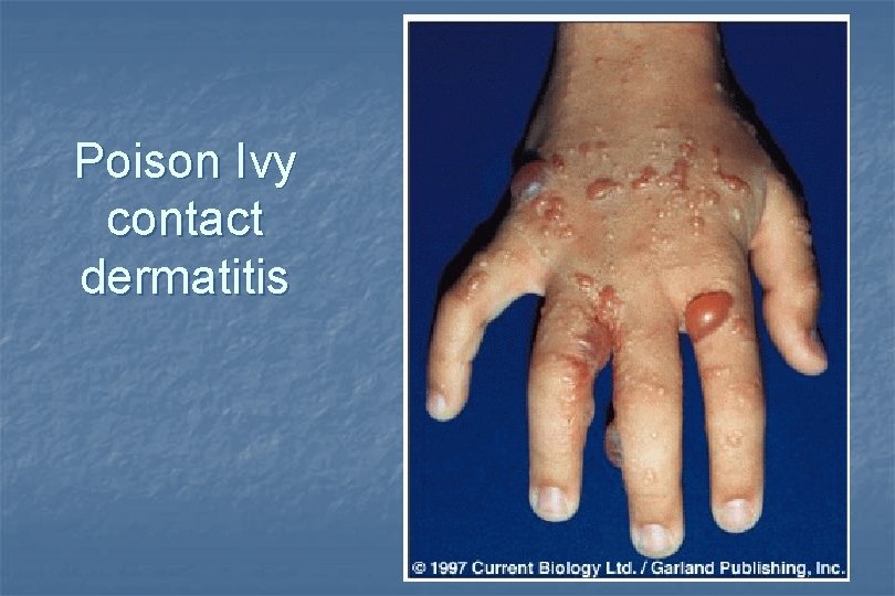 Poison Ivy contact dermatitis 