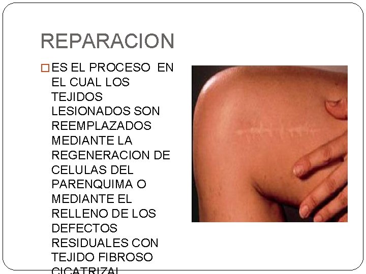 REPARACION � ES EL PROCESO EN EL CUAL LOS TEJIDOS LESIONADOS SON REEMPLAZADOS MEDIANTE