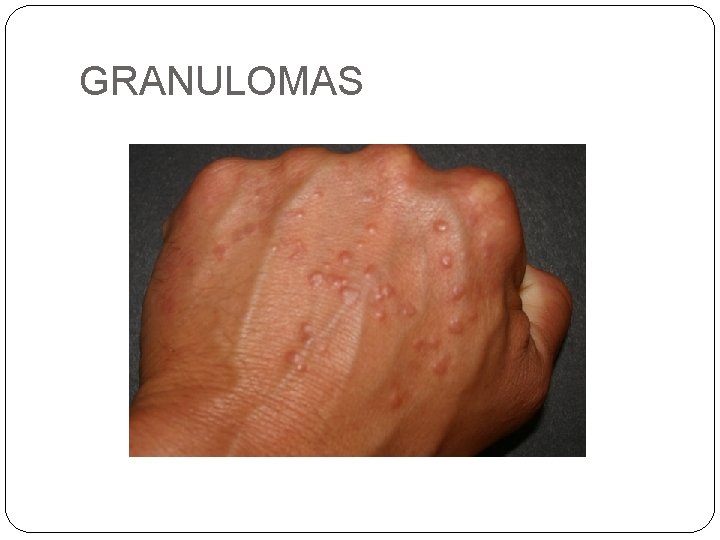 GRANULOMAS 