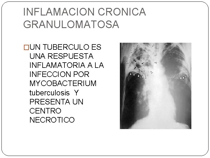 INFLAMACION CRONICA GRANULOMATOSA �UN TUBERCULO ES UNA RESPUESTA INFLAMATORIA A LA INFECCION POR MYCOBACTERIUM