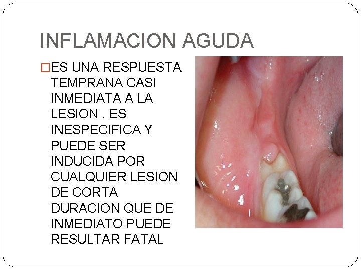 INFLAMACION AGUDA �ES UNA RESPUESTA TEMPRANA CASI INMEDIATA A LA LESION. ES INESPECIFICA Y