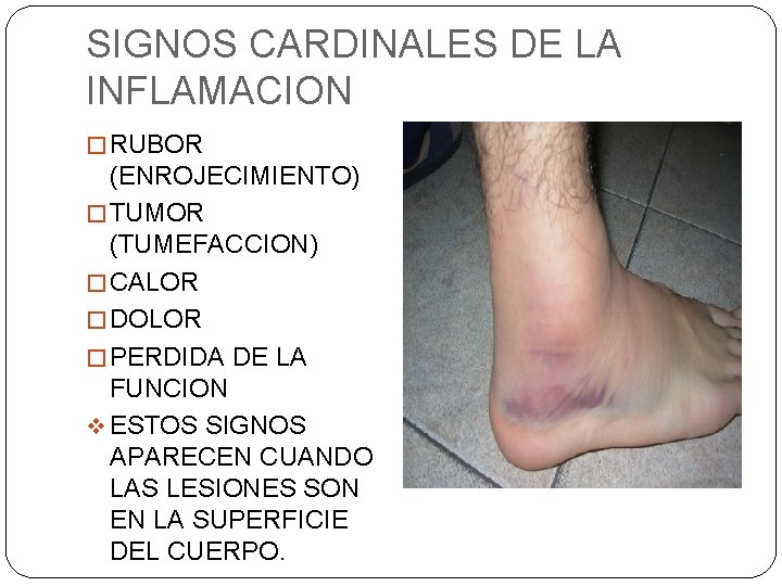 SIGNOS CARDINALES DE LA INFLAMACION � RUBOR (ENROJECIMIENTO) � TUMOR (TUMEFACCION) � CALOR �