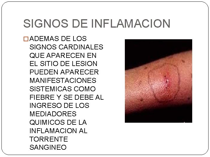 SIGNOS DE INFLAMACION � ADEMAS DE LOS SIGNOS CARDINALES QUE APARECEN EN EL SITIO