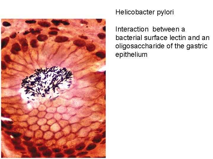 Helicobacter pylori Interaction between a bacterial surface lectin and an oligosaccharide of the gastric