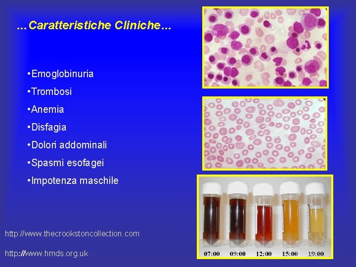 …Caratteristiche Cliniche… • Emoglobinuria • Trombosi • Anemia • Disfagia • Dolori addominali • …Caratteristiche Cliniche… • Emoglobinuria • Trombosi • Anemia • Disfagia • Dolori addominali •