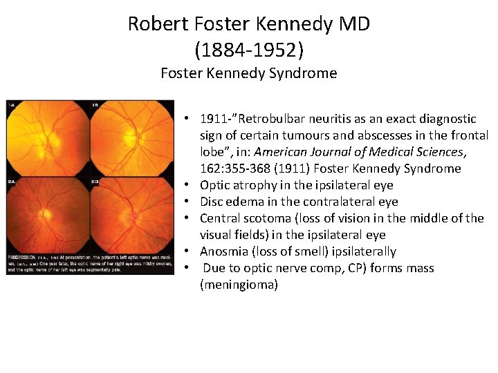 Robert Foster Kennedy MD (1884 -1952) Foster Kennedy Syndrome . • 1911 -”Retrobulbar neuritis