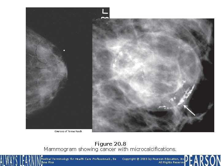 Figure 20. 8 Mammogram showing cancer with microcalcifications. Medical Terminology for Health Care Professionals,
