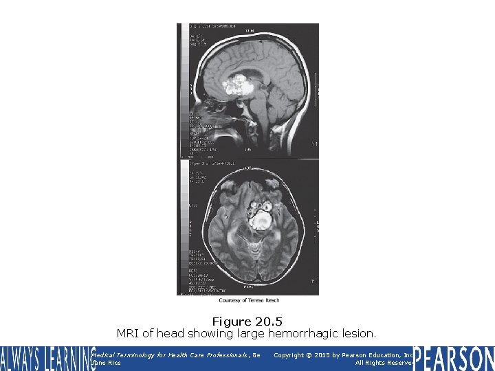 Figure 20. 5 MRI of head showing large hemorrhagic lesion. Medical Terminology for Health