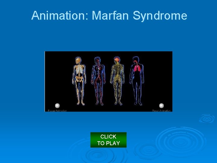 Animation: Marfan Syndrome CLICK TO PLAY 